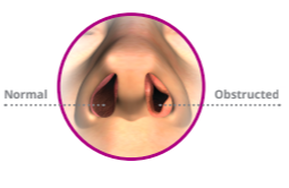 airway remodeling